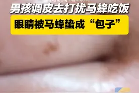 7月27日 贵州黔南。男孩调皮去打扰马蜂吃饭，眼睛被马蜂蛰成“包子”#原谅我不厚道的笑了 #哭笑不得 #马蜂蜇人视频封面
