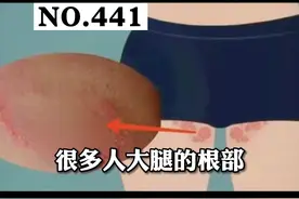 大腿内侧长红斑，难以启齿，以为是性病？其实#科普 #股癣 #联苯苄唑喷雾 视频封面