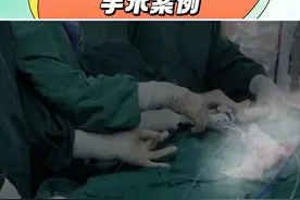 A型夹层全腔内重建系统手术案例#华西医院 #心脏大血管外科 #案例分享 #微创手术视频封面