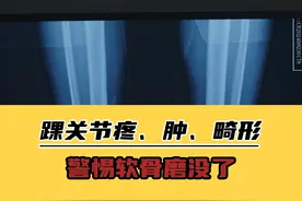 踝关节疼、肿、畸形？警惕软骨磨没了 #医学科普 #运动康复视频封面