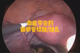 最简单的输卵管切除/结扎 你们能学会吗#硬核健康科普行动视频封面