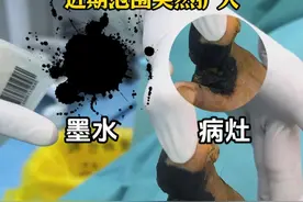 脚上黑斑黑的像墨水，几十年没当回事，近期范围扩大 #黑色素瘤  #硬核健康科普行动  #肿瘤专家王春萌 #医疗健康创作训练营 #手术视频封面