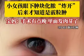 小女孩眼下肿块化脓“炸开”，后来才知道是霰粒肿，宝妈开始带孩子去区里的医院割过一次，没清理干净更严重了，又去市级医院做手术，里面已经开始长肉芽了。#霰粒肿 #霰粒肿术后 #霰粒肿有什么办法解决视频封面