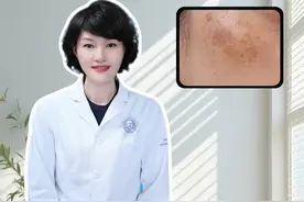 长春吉大一院皮肤科，钟教授教你自测你是哪种斑 #黄褐斑雀斑 #皮肤健康 #长春 #知识点亮她 #抖出健康知识宝藏视频封面