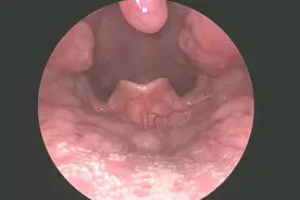 了解一下舌扁桃体
#医学科普 #健康科普视频封面