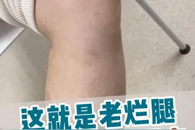 大姐从呼伦贝尔远道而来，静脉曲张已经导致老烂腿，别担心，这也能治。#静脉曲张 #静脉曲张彭军路主任 #医大一院静脉曲张微创诊疗中心 #河北医大一院血管外科团队 #硬核健康科普行动视频封面