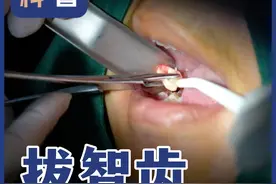 拔智齿要上千块？ #硬核健康科普行动 #医学科普 #智齿 #种植牙 #北京视频封面