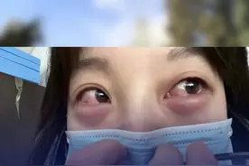 北京花粉过敏季致女子眼睛出现红肿 园林局回应 目前，北京市已进入春季花粉过敏高峰期，柏树花粉的过敏人群数量最多。许多花粉过敏的患者在近期都出现了眼睛痒、出现血丝红肿、打喷嚏等症状。视频封面