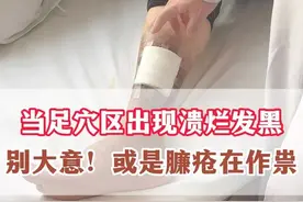 当足穴区出现溃烂发黑，别大意！或是臁疮在作祟 当足穴区出现溃烂发黑，别大意！或是臁疮在作祟#抖出健康知识宝藏  #情绪松绑给心灵放个假 #李建鹏 #臁疮 #脚部溃烂 视频封面