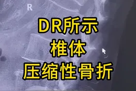 DR所示椎体压缩性骨折 #医学影像 #医学生 #腰痛 #骨折视频封面