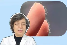 手上感觉扎了刺却找不到，也很难弄出来，可能是扎到玻璃纤维了，医生教你如何处理！#科普 #生活小妙招 #健康 #扎刺 #涨知识