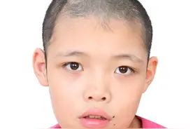 郴州寻亲：11岁女孩在佛山被救助多年，头部右侧有疤痕图片