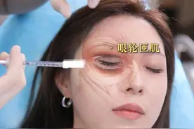 实拍肉毒除皱画面，鱼尾纹有救了！ #面部注射 #肉毒素 #鱼尾纹 #除皱针 #抗衰老视频封面