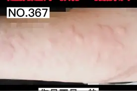 一热一运动就痒怎么办？看完这个视频帮到你 #胆碱能性荨麻疹 #红疹 #荨麻疹 #科普 视频封面