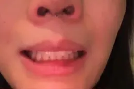 女子想要刘亦菲同款驼峰鼻，结果整毁了?#社会百态 #万万想不到 #女性智慧视频封面