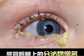 感冒后眼睛上的分泌物增多，是怎么回事？ #硬核健康科普行动  #年度健康知识干货大赏视频封面