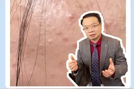 摸起来粗糙的反复发作的闭口，能不能做针清？#皮肤科医生谢红付 #针清 #闭口 #硬核健康科普行动视频封面