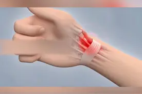 腱鞘炎是怎么形成的？ #腱鞘炎 #健康 #涨知识视频封面