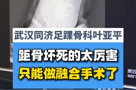 距骨坏死的太厉害了,只能做融合手术保不了了 #距骨 #距骨坏死 #硬核健康科普行动视频封面