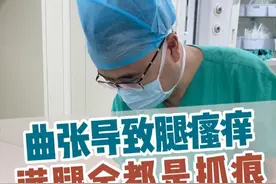 静脉曲张导致皮肤瘙痒，满腿都是抓痕，大姐从山东潍坊来石家庄找我治疗。#静脉曲张 #静脉曲张彭军路主任 #医大一院静脉曲张微创诊疗中心 #河北医大一院血管外科团队 #硬核健康科普行动视频封面