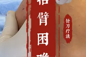抬臂困难，手臂伸不直，可能是冈上肌腱损伤了，小针刀治疗 #小针刀 #手臂疼痛 #手臂发凉 #针刀王萍 #硬核健康科普行动视频封面