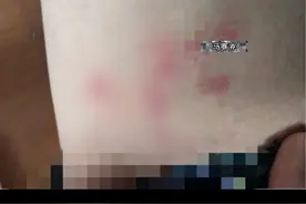 #皮肤健康大腿根部红斑剧烈瘙痒，一抓容易形成一大片，还容易留下黑印子，可以这样处理。#股癣 #医学知识科普 