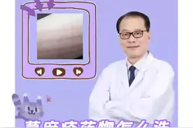 荨麻疹药物怎么选，外用好还是口服好？
#皮肤过敏 #过敏 #硬核健康科普行动视频封面