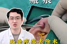 耳垂疙瘩去除术，不改变原本形态 #耳垂瘢痕疙瘩 #瘢痕 #手术室故事  #北医三院张辰博士视频封面
