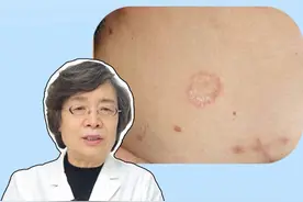 身上长这种很痒的红斑，是会传染的，别用手抓！#体癣 #股癣 #传染 #健康 #硬核健康科普行动视频封面