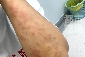 #李子柒 携“雕漆隐花”复出，生漆严重过敏全身发痒红肿，依旧坚持学漆。老师钦佩：她绝不是花架子。#李子柒生漆过敏画面曝光视频封面