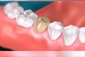 拔牙后不及时镶牙会出现什么问题#牙齿健康 #小和宝典 视频封面
