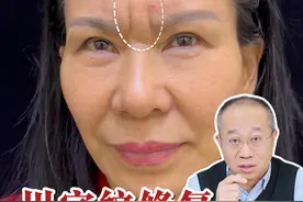 川字纹修复为什么会比初次做贵很多？贵在哪里？难在哪里？ #川字纹 #川字纹效果太棒了 #任冲川字纹 #川字纹任冲 #任冲拯救重度川字纹视频封面