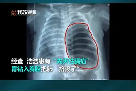 两月龄男婴胃钻进胸腔把肺挤没了#江苏dou知道 #政媒原创作者联盟视频封面