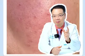脸上一遇冷遇热就容易微微发红，有时候还伴随着发烫这是怎么回事？#皮肤科医生谢红付 #玫瑰痤疮 #硬核健康科普行动  #谢红付与玫瑰痤疮视频封面