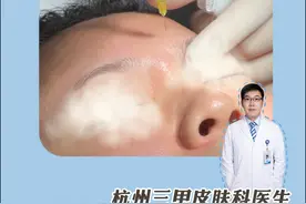 恐怖❗300元两针肉毒，打完进ICU了 看到这些案例，真的很惊心，所以有些话真的必须要跟你们讲！纯干货分享，要打肉毒的宝子看好了！

👉怎么判断自己有没有肉毒中毒？当你打完肉毒出现这些症状一定要去医院及时医治。
一般中毒之后会出现头晕眼花、乏力、颈项乏力、视力模糊，
再往后严重的话可能会出现说话障碍、吞咽困难、饮水💦呛咳，
更严重的就是呼吸衰竭，甚至危及生命。
👉那到底为啥会肉毒中毒?
最常见的中毒原因就是毒素的【剂量过大】，肉毒素是被归到了医疗用毒性药品的管理之内，本质是有毒药品，所以使用它必须遵循毒素药品的管理规定。超量注射或者不当注射，都是会威胁我们自身生命安全的，而这本质的原因，就是
【医生没资质】，【技术不到位】。

其次就是假冒伪劣产品频发！肉毒素药品有需要全流程追溯的相关政策，也就是说这个药品必须由国家来指定，医疗企业才能生产。事实上很多中毒的患者使用的产品，都是非法来源或者不明来源。有的假药一瓶甚至达到1000u，想想这种东西打在身上，不感到害怕吗？
一句话总结：
【医院🚑正规+药品正规】。
👉当然，不排除有些人群由于自身身体原因不能打肉毒。
#硬核健康科普行动   #樊哥撩皮肤  #听医生一句劝  #肉毒  #眼周细纹视频封面