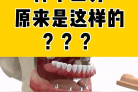 用四颗钉就能种半口牙，你见过吗#口腔科普 #一口好牙 #种植牙视频封面