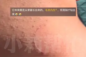 2月6日 采访 西班牙 提示：看视频不用呲牙咧嘴。男子胡子长进皮下爱人拿镊子丝滑取出。网友：这是毛发内生，吓得我对着镜子看了半天 （视频来源：@🇨🇳꧁꧁ 𝕛ꫀꪀꪀꪗ꧂꧂🇪🇸 ）视频封面