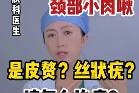 颈部小肉粒到底是皮赘还是丝状疣？皮赘该涂什么药膏？千万别搞错了！！！#dou来说健康 #皮赘涂什么药膏 #丝状疣 #皮赘 #皮赘和丝状疣区别视频封面