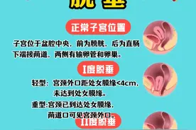 一张图看明白子宫脱垂 #子宫脱垂 #前壁膨出 #妇产科周书明 #医学小知识 #抖出健康知识宝藏视频封面
