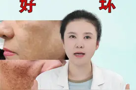 怎么辨别黄褐斑加重了还是要消退？ #黄褐斑 #反黑 #皮肤美容 #祛斑 #硬核健康科普行动视频封面