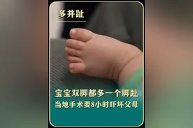 宝宝双脚都多一个脚趾 当地手术要8小时吓坏父母#多并趾 #多趾 #人类幼崽的脚丫子 #手术 #记录宝宝视频封面
