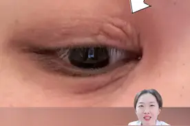 眼睛越挠越痒，你可能有神经性皮炎！ #神经性皮炎 #眼睛痒 #压力 #情绪 #硬核健康科普行动视频封面
