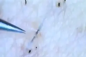 逆向生长的毛发该怎么办 #科普视频封面