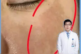 三甲皮肤科|黄褐斑三明治疗法配套如何护肤？ 黄褐斑护肤三件套：①早胺晚氨  ②早胺晚熊 ③早胺晚酸
第一阶段：不稳定期黄褐斑
状态：色素明显 血管扩张  火火问题
方法：烟酰胺+氨甲环酸  使用1-2个月
第二阶段：黄褐斑趋于稳定
状态：色斑淡化，黄褐斑稳定，针对黑色素对症下yao
方法：络氨酸酶有关的变白护肤品， 氢醌 熊果苷，377，630等等
使用早胺晚熊或者早胺晚醌
白天：烟酰胺+氨甲环酸  晚上：烟酰胺+氢醌或者烟酰胺+熊果苷 使用1-2个月
第三阶段：色素斑更加稳定，但是有些点状色素无法代谢出，依然停留在皮肤表面
方法：早胺晚酸 
白天：烟酰胺+氨甲环酸 晚上：果酸或者A醇+熊果苷 针对色斑点状涂抹 油皮用果酸 干皮或者中性皮用A醇
#抖出健康知识宝藏    #情绪松绑给心灵放个假    #黄褐斑  #护肤  #樊哥撩皮肤视频封面
