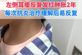 这是耳瘘做手术最好的状态#医学科普 #耳前瘘管 #硬核健康科普行动  #听医生一句劝视频封面