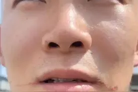 6月19日，内蒙古呼和浩特。男子着急吃烧烤，嘴巴被铁签子烫出一串痕迹。网友：撸串撸出火星子了？视频封面