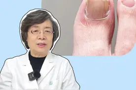#灰指甲 总是反复治不好？医生一条视频教你怎么去根！#医学科普 #灰指甲用什么药 #健康 #灰指甲初期的照片视频封面