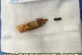 湖南8岁女童玩耍时被铅笔扎伤脚底 3个月后竟确诊慢性骨髓炎 医生从脚里取出完整铅笔和笔芯#广东dou知道 #孩子 #危险瞬间视频封面