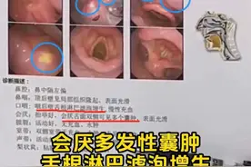 #会厌囊肿 #舌根淋巴滤泡增生 造成异物感；主任:手术可以明显改善。#医学科普 #医学小常识 #抖音健康视频封面