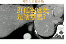 肝脏小的低密度灶，医生告诉你无法排除恶性？20241031视频封面